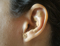 Auricular Therapy St. Petersburg FL